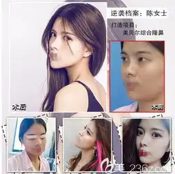 闺蜜给我看找黄名斗医生做的韩式重睑术后效果还分享南京美贝尔4月整形优惠价格表