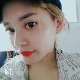 双眼皮已经快两百天咯,是不是很好看了呢闺蜜是现在...双眼皮悦美整形