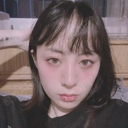 今天逛街的时候,我闺蜜夸我好看哈哈哈哈真开心...鼻综合悦美整形