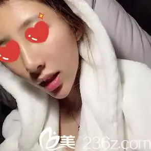 闺蜜看到我在长沙禾丽整形医院做的综合假体隆鼻术后1个月恢复效果后说也想去做
