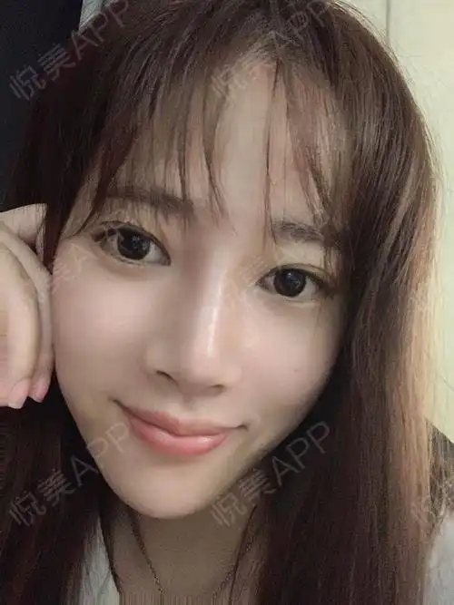 已经迫不及待给你们分享我的术后感受了,做完手术的当...填充塑形悦美整形