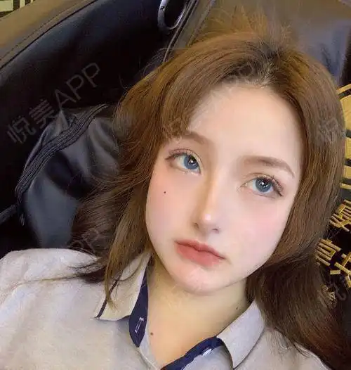 现在比较稳定了,约了好久不见的闺蜜,闺蜜说我变漂亮...隆鼻悦美整形