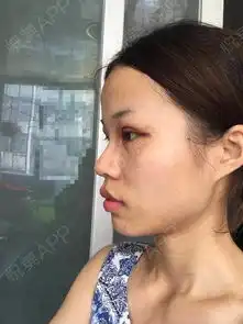 本人是口腔医院的,也算是医美人吧,眼睛一边单眼皮一...双眼皮悦美整形